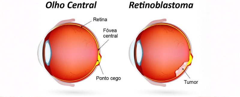 Comparação entre olho normal e retinoblastoma